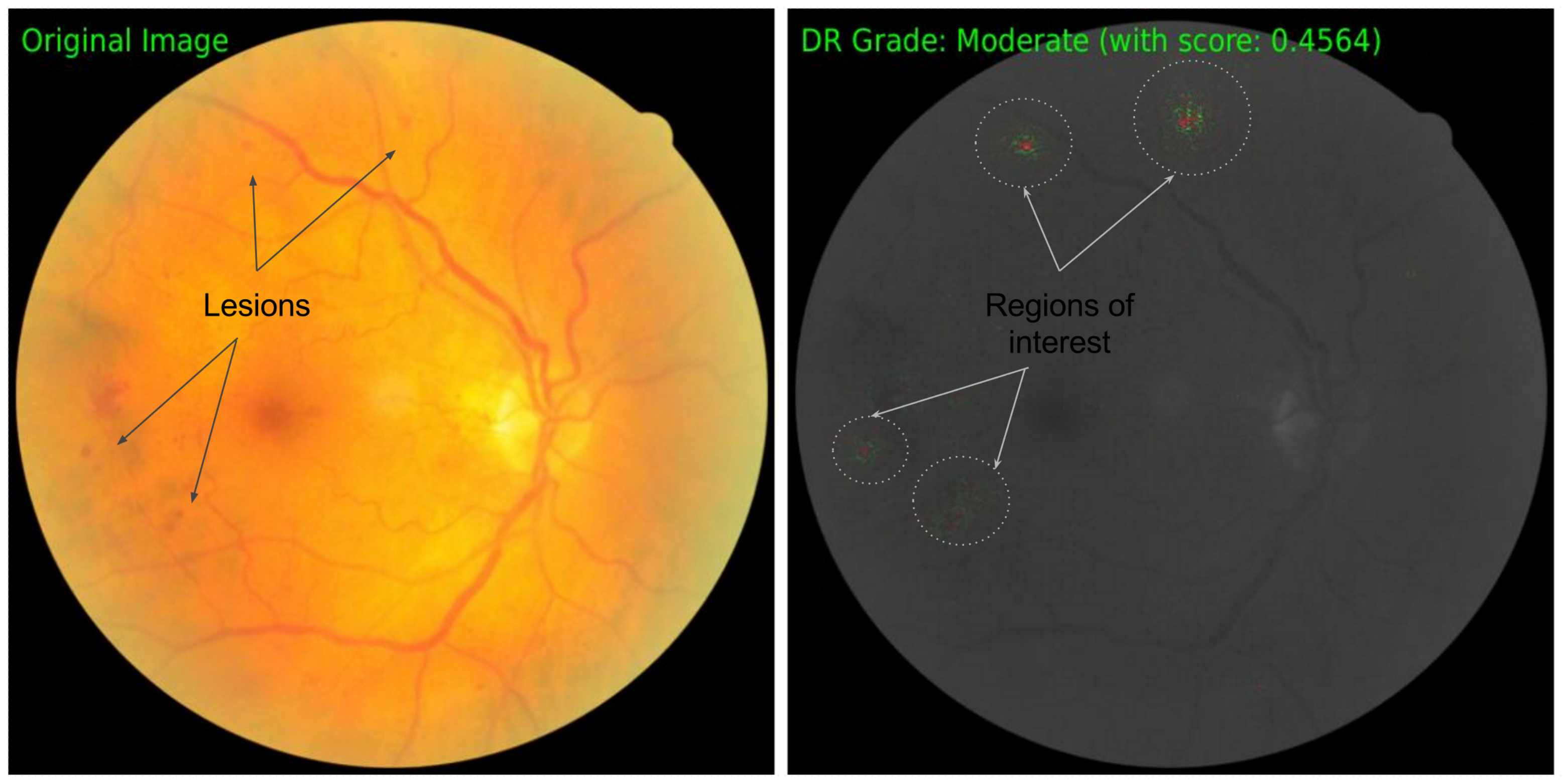 **Figure 3:** **Attribution for Diabetic Retinopathy grade prediction from a retinal fundus image.** The original image is show on the left, and the attributions (overlayed on the original image in gray scaee) is shown on the right. On the original image we annotate lesions visible to a human, and confirm that the attributions indeed point to them.